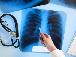 В Запорожской области обнаружили туберкулез открытой формы: больных срочно госпитализировали