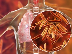 В Каменском стали чаще умирать от туберкулеза