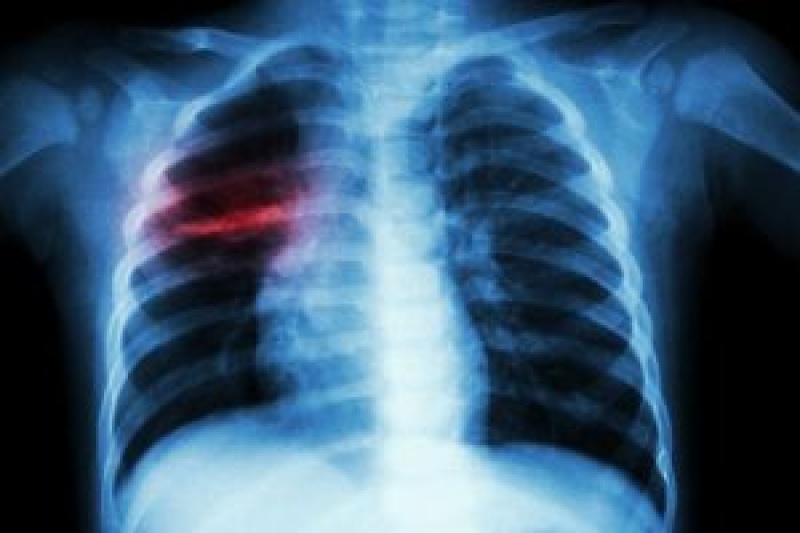 Днепропетровщине грозит эпидемия туберкулеза