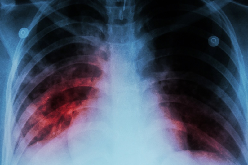 На Сумщині фіксують зростання захворюваності на туберкульоз серед дітей