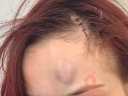 В Одессе ТЦКашник избил девушку костылями. Теперь ей за это грозит 8 лет тюрьмы
